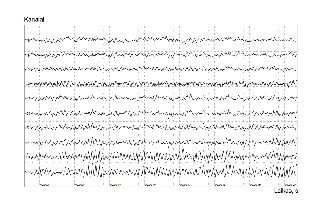 Pav. 1. Elektroencefalogramos užrašo pavyzdys. 10 registravimo kanalų – viena kreivė, vienas kanalas, pateiktas 8 s įrašas – vertikalios juostos žymi 1 s 